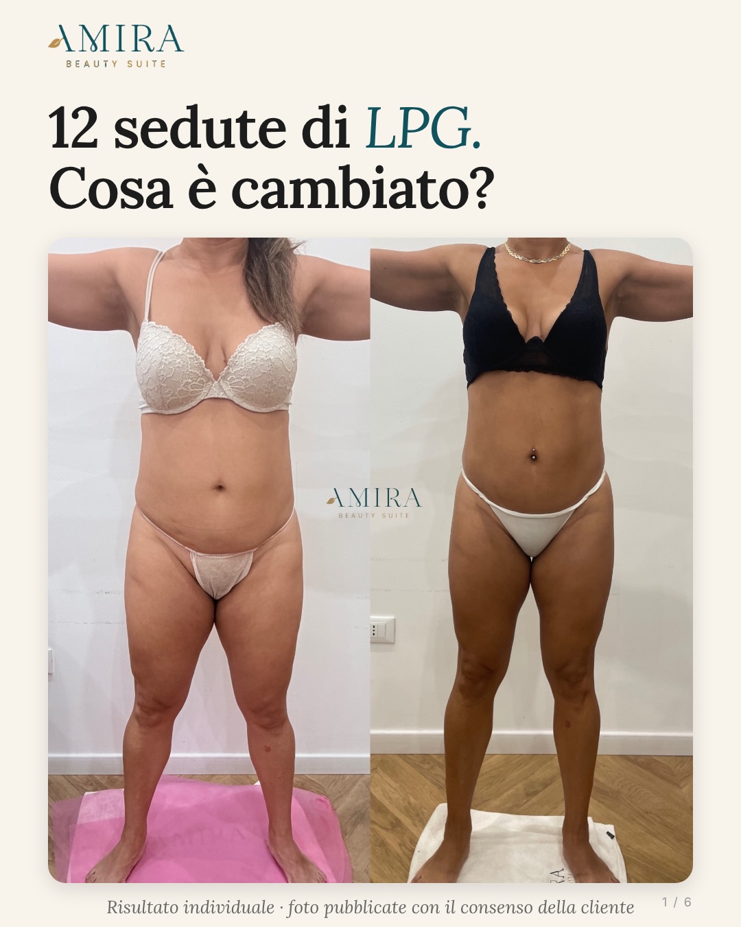 Front view before and after the 12-session LPG programme shared by Amira Beauty Suite