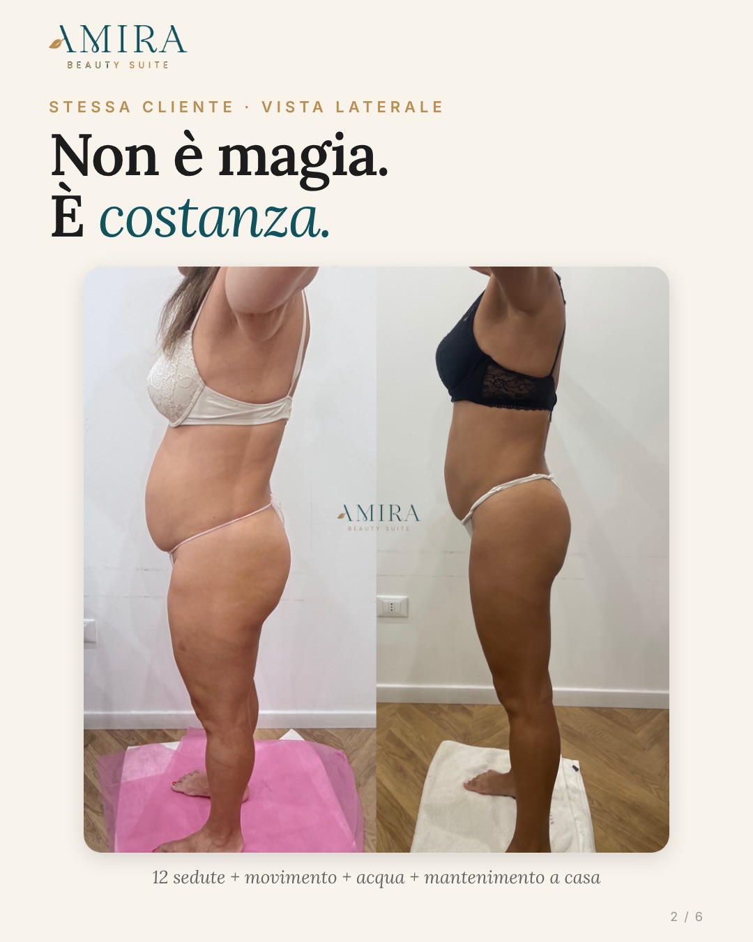 Side view of the same client before and after her LPG programme, with details of 12 sessions and daily habits
